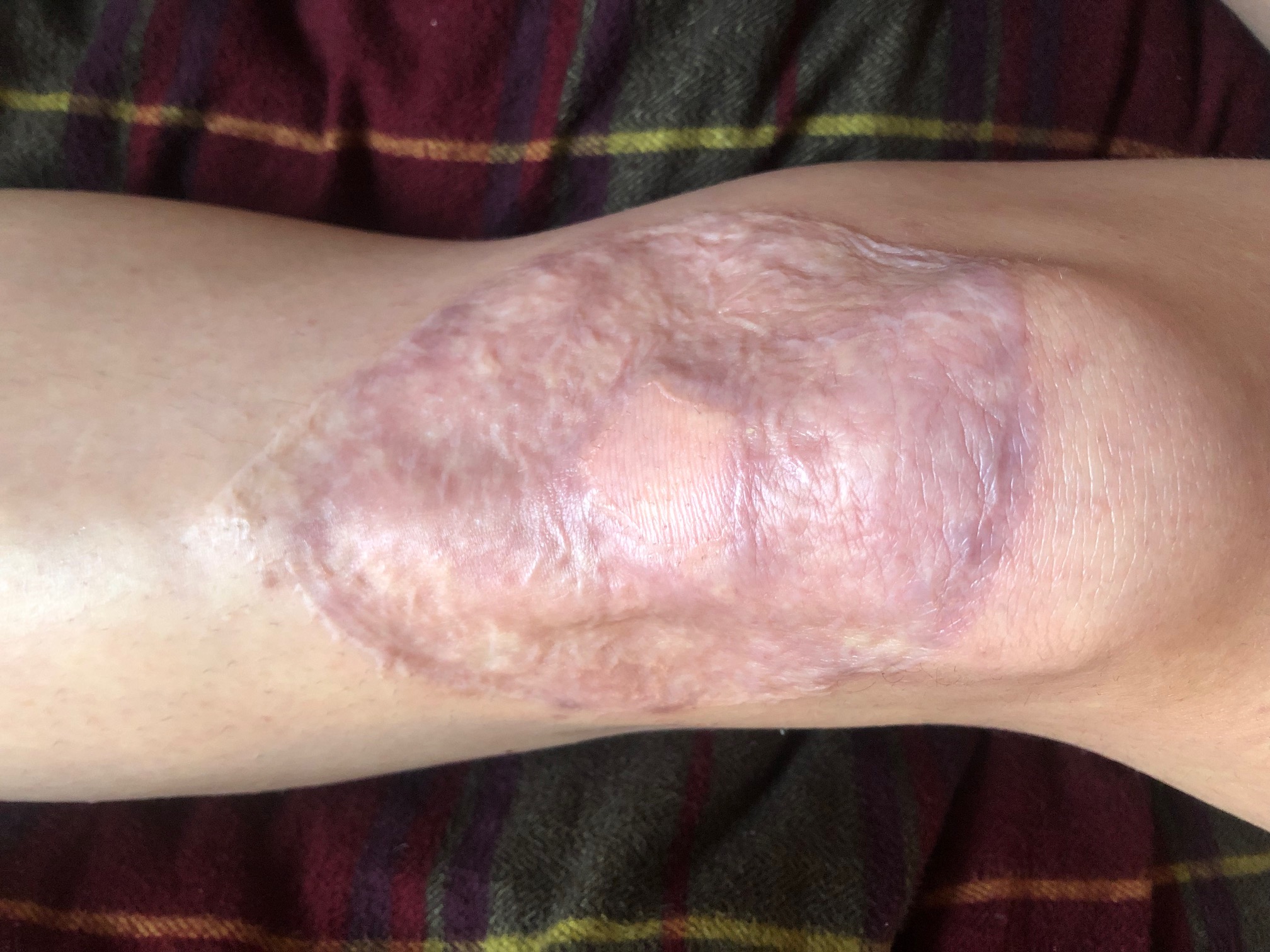 Blog about knee skingraft