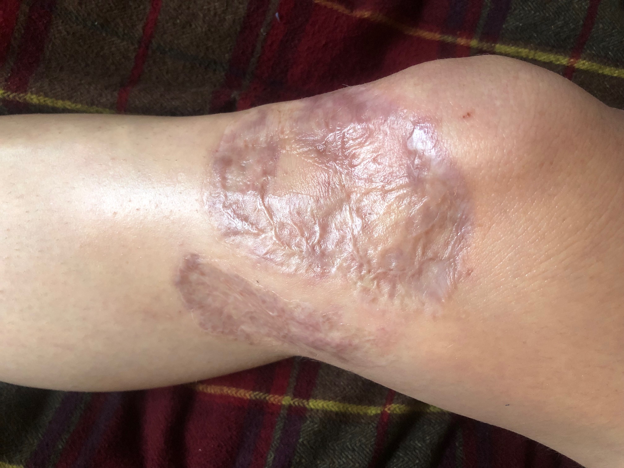 Blog about knee skingraft