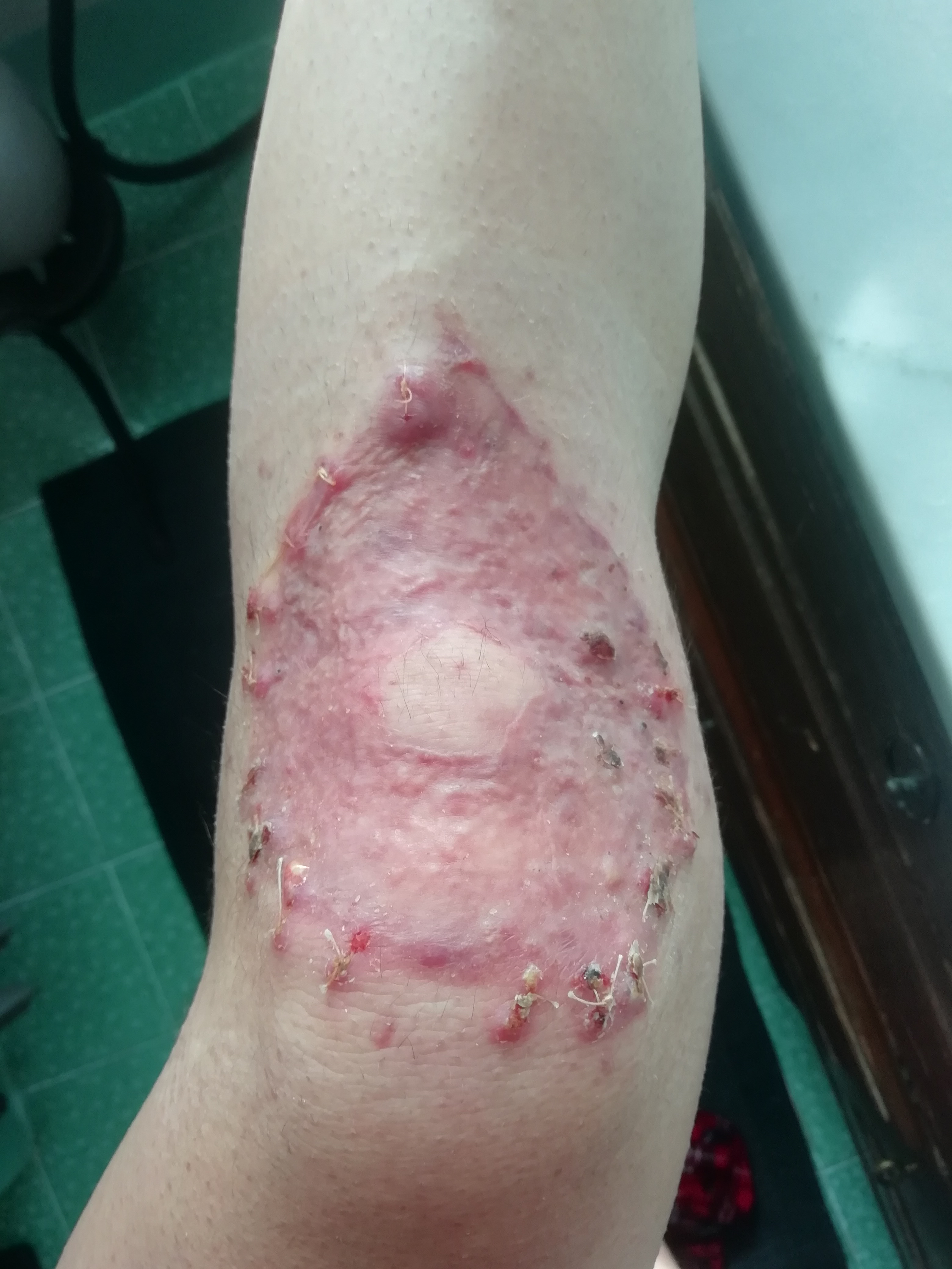 Blog about knee skingraft