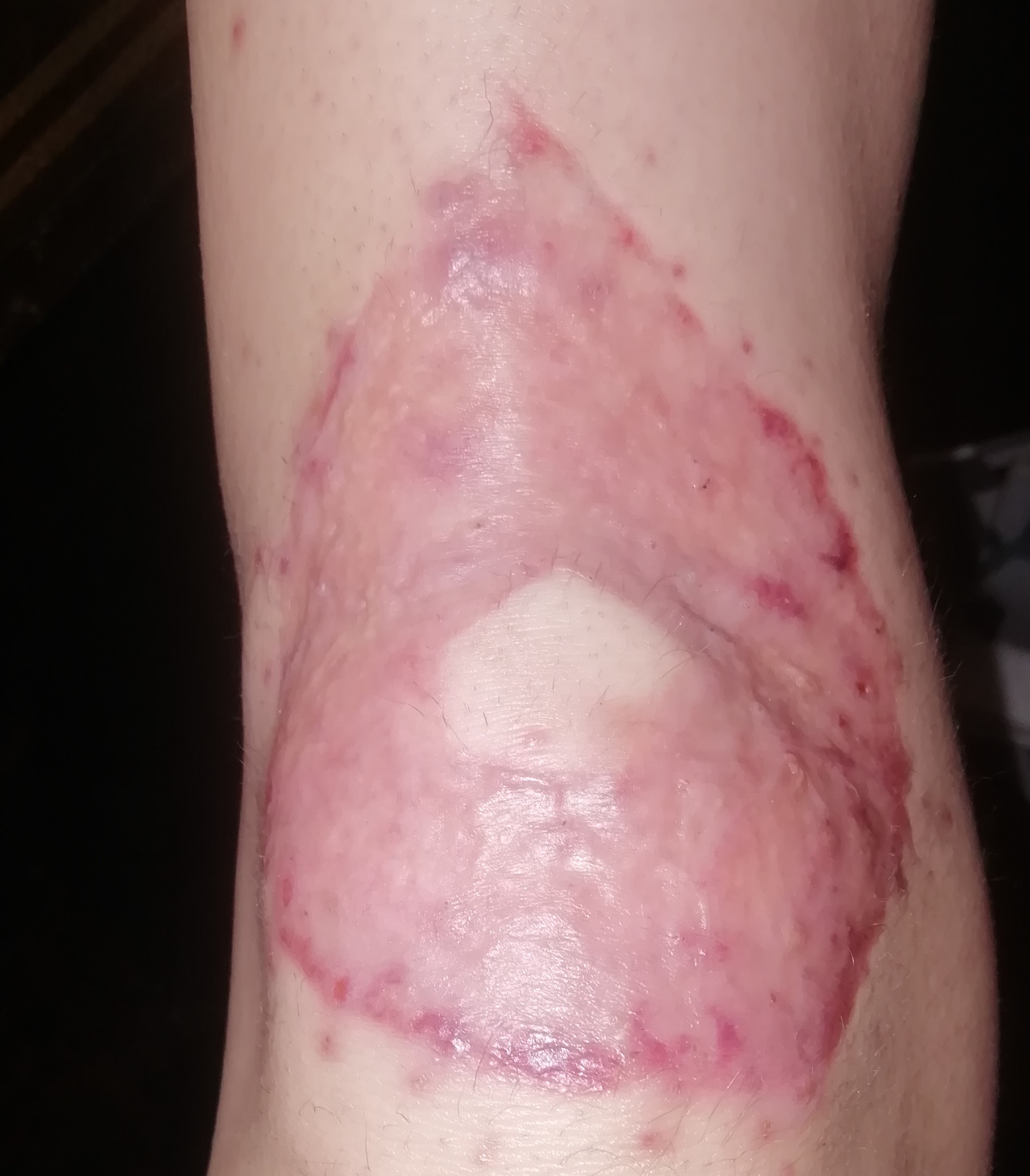 Blog about knee skingraft