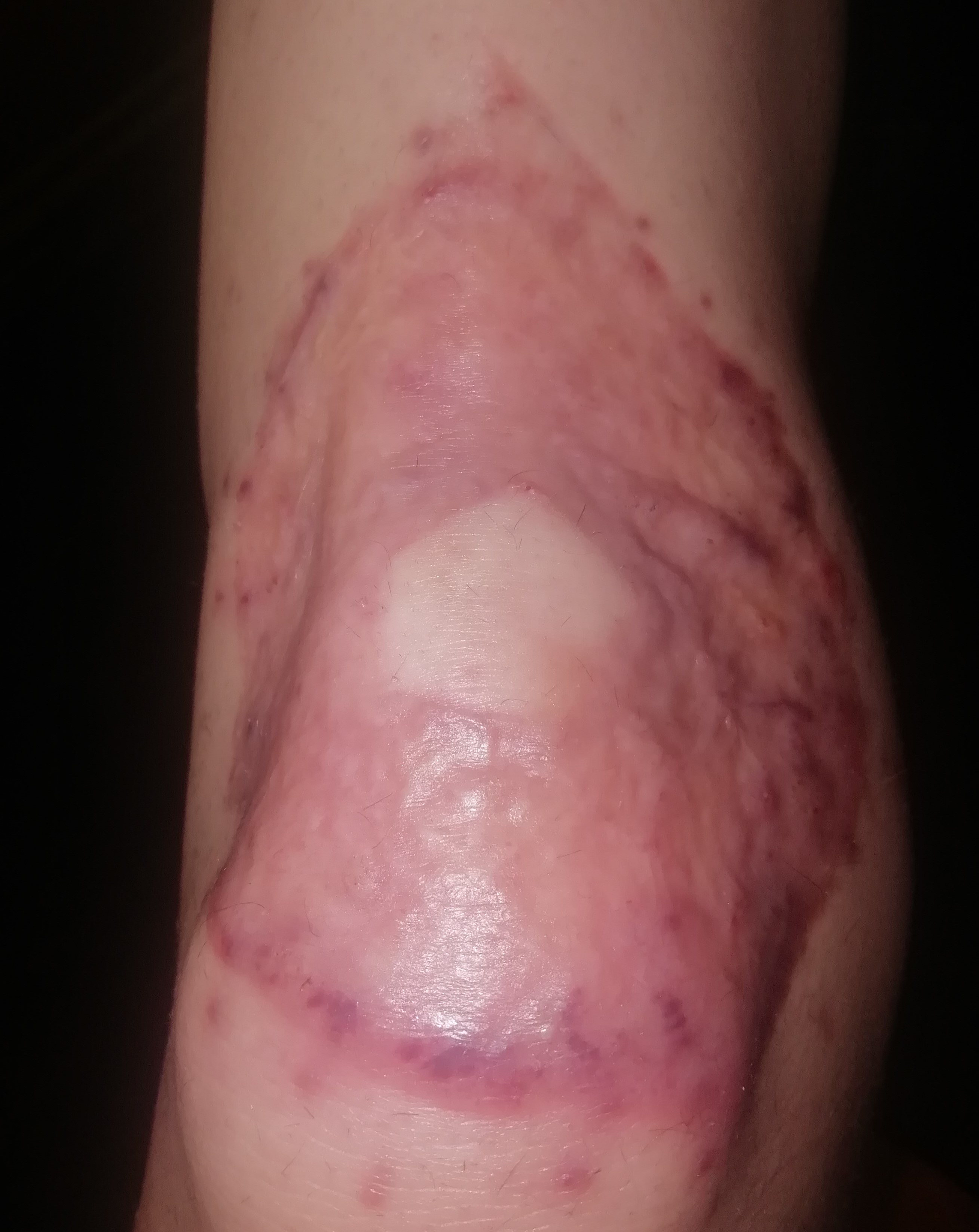 Blog about knee skingraft