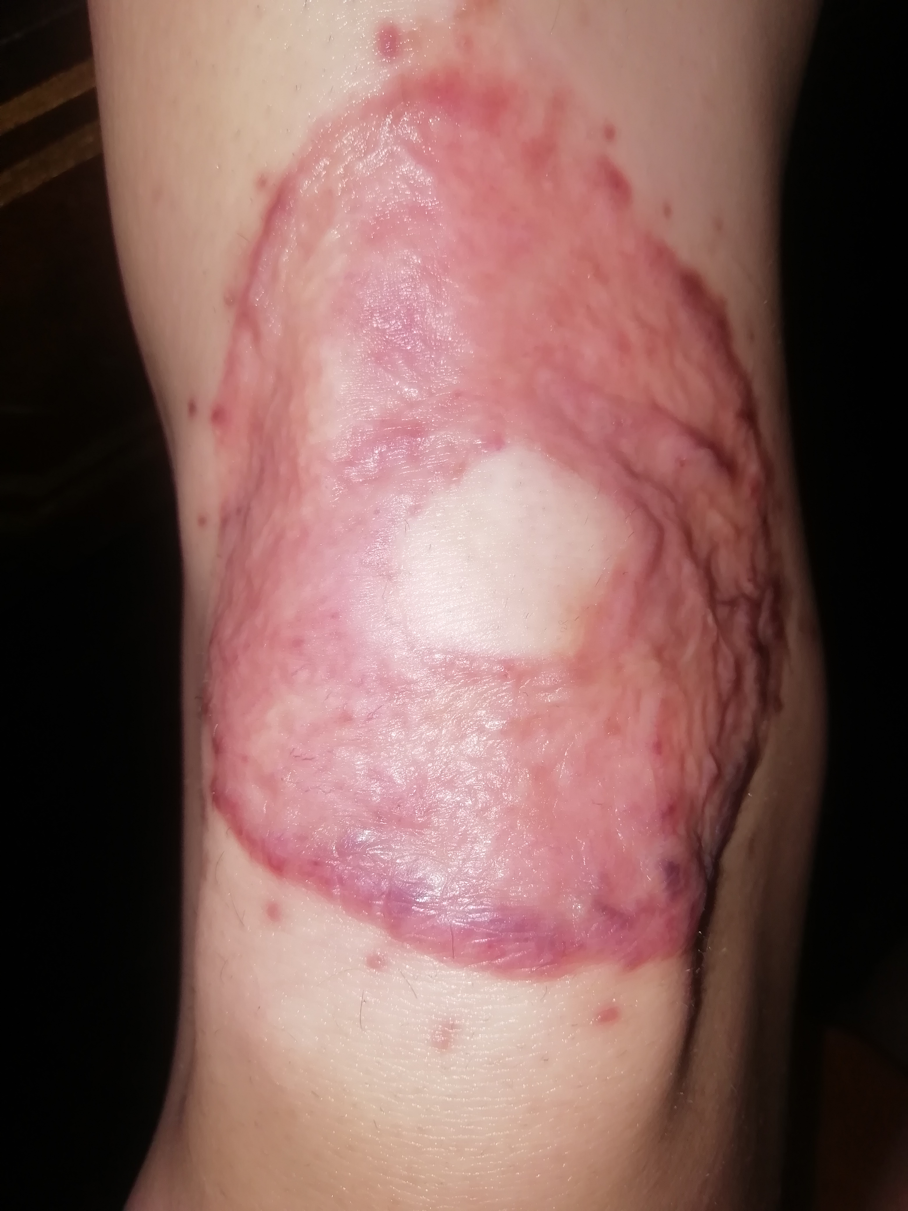 Blog about knee skingraft