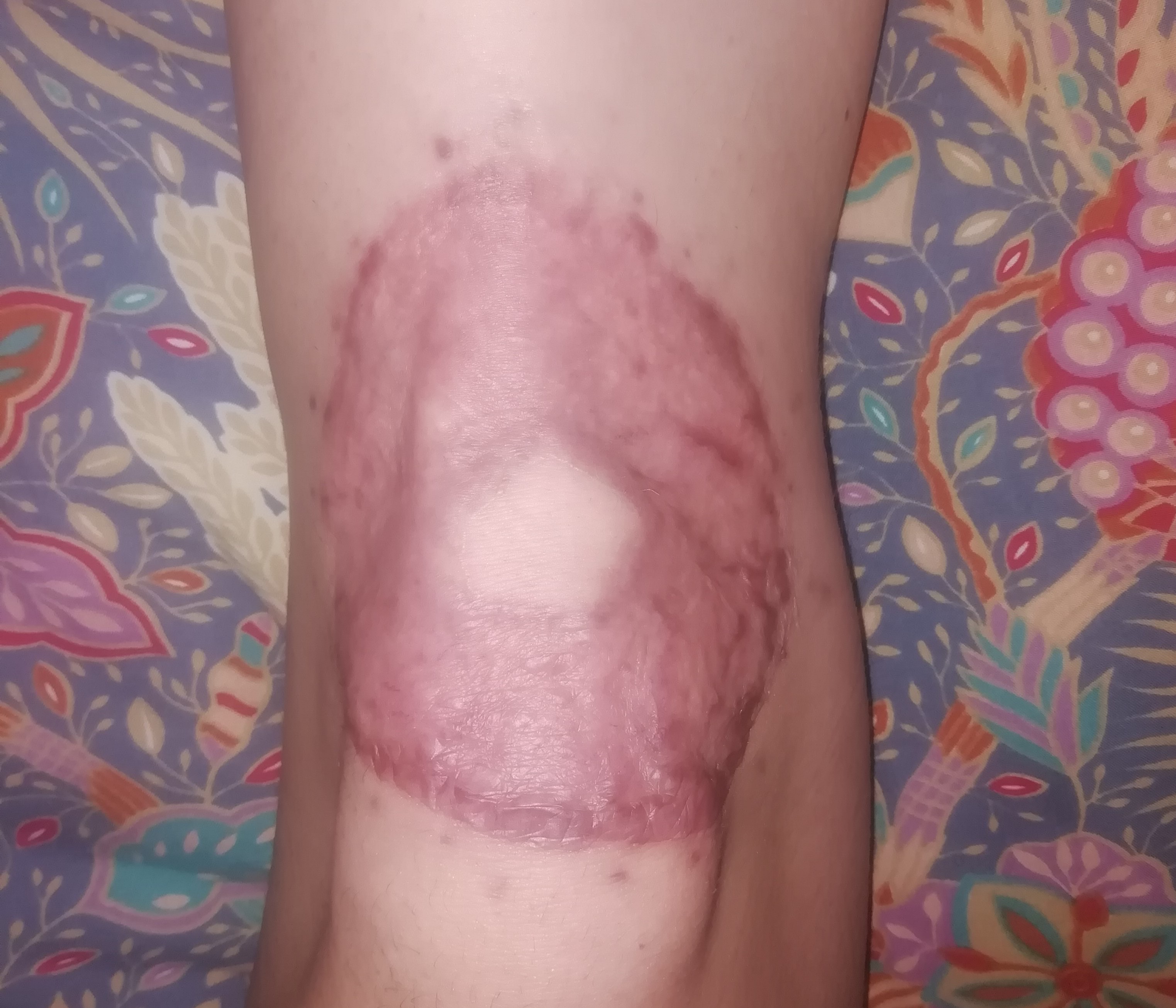 Blog about knee skingraft