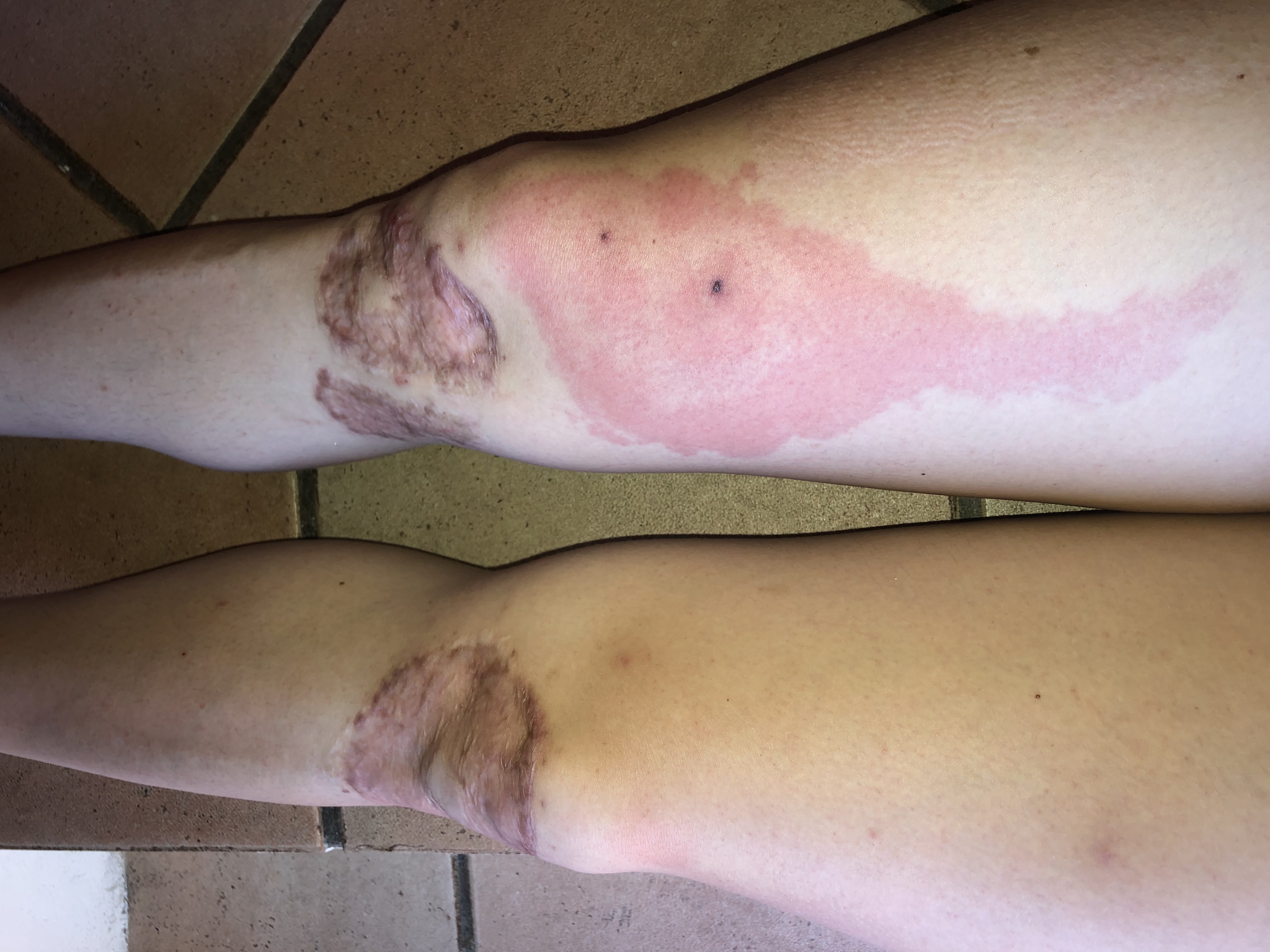 Blog about knee skingraft