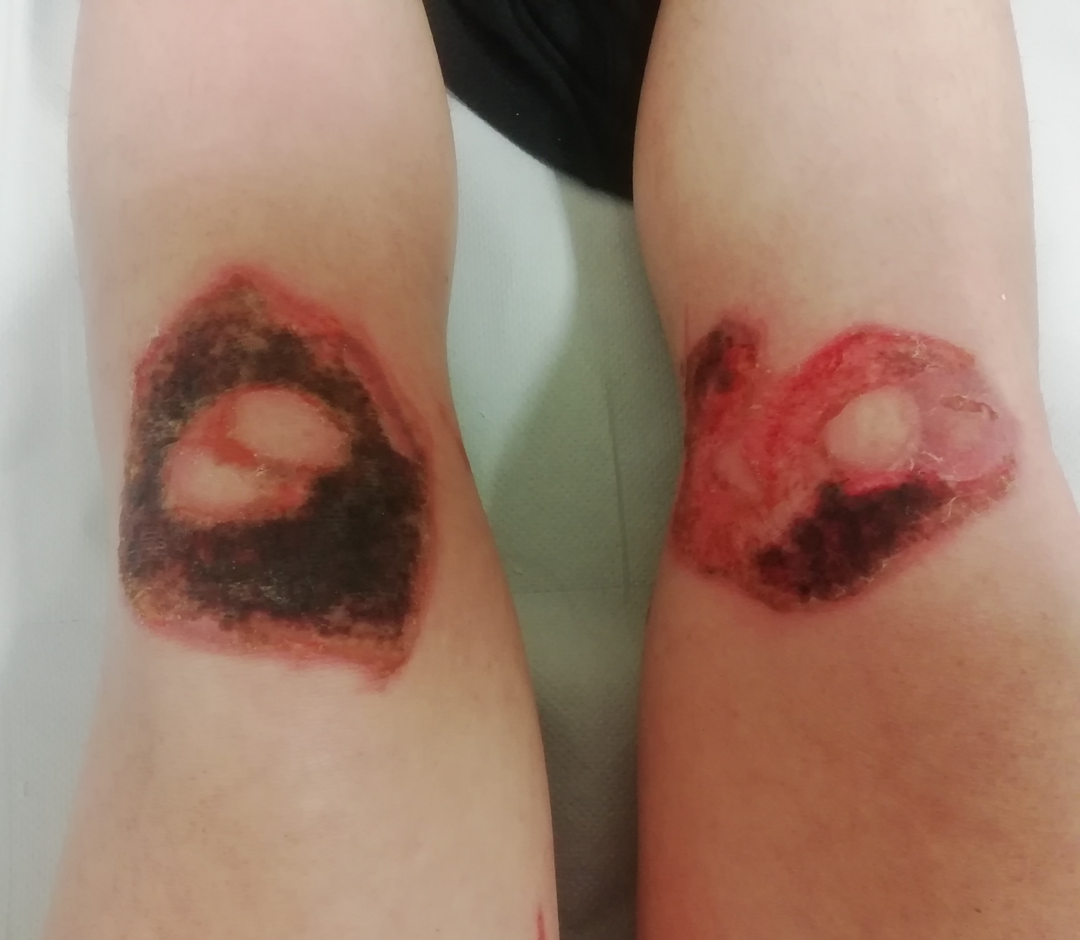 Blog about knee skingraft