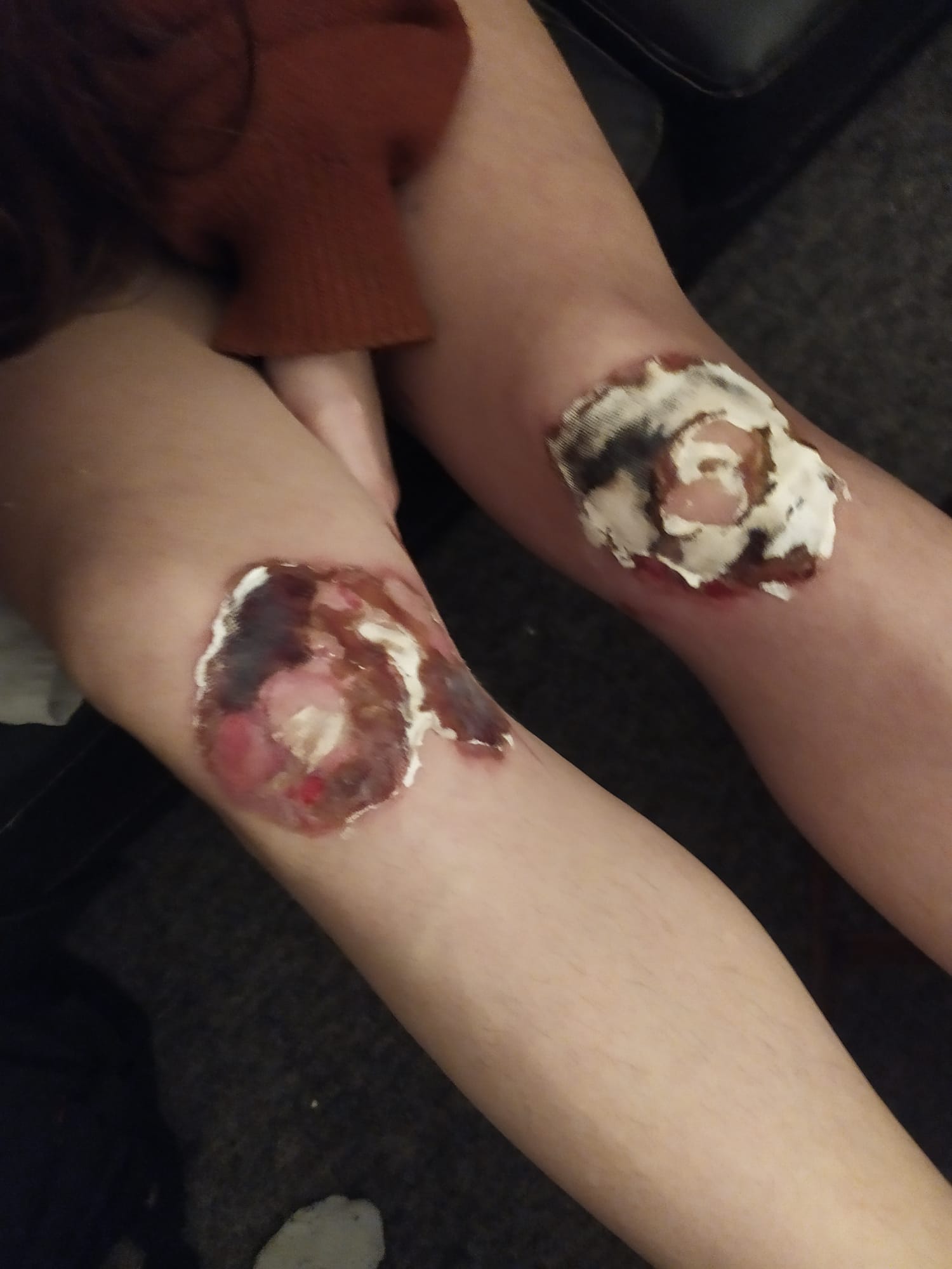 Blog about knee skingraft