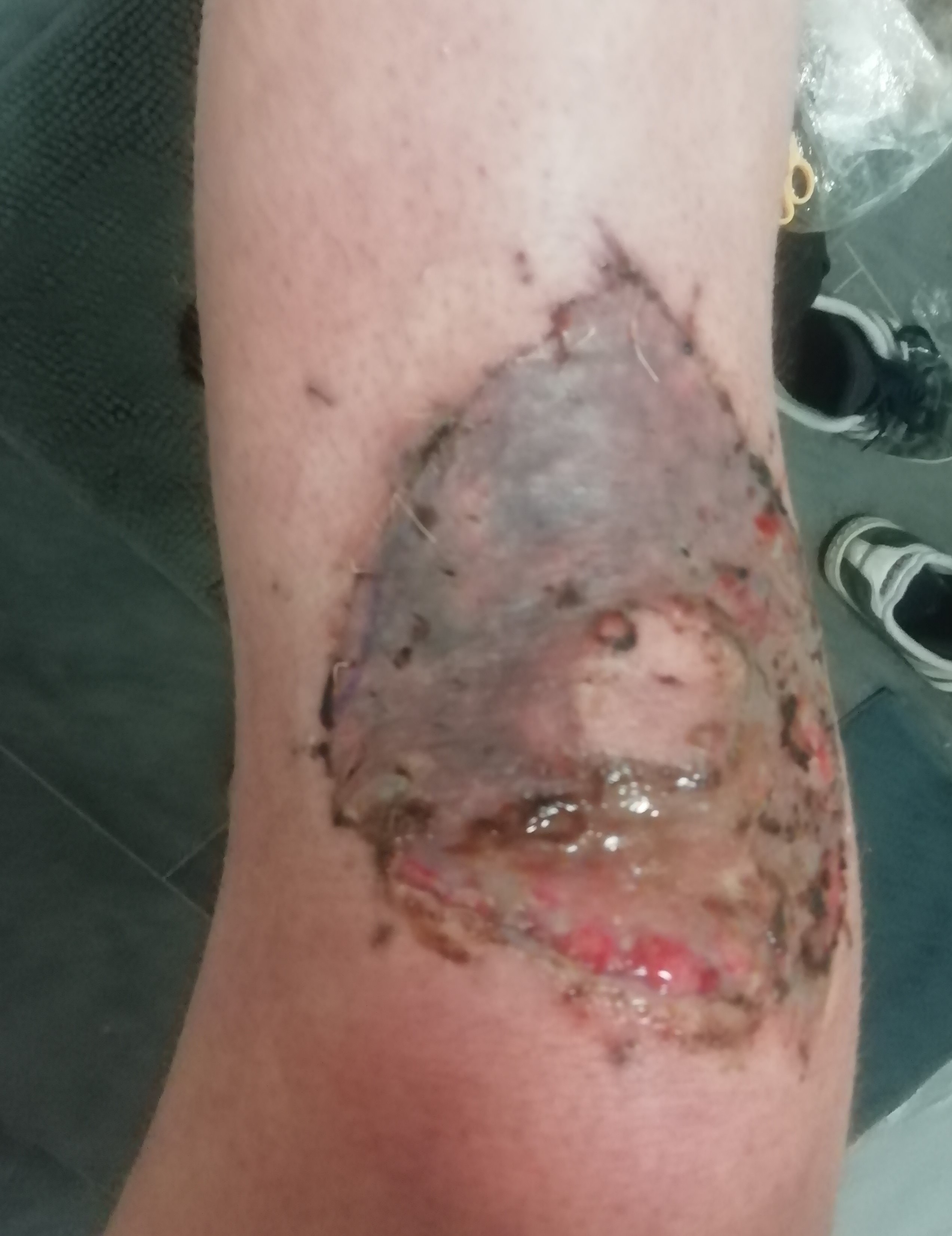 Blog about knee skingraft