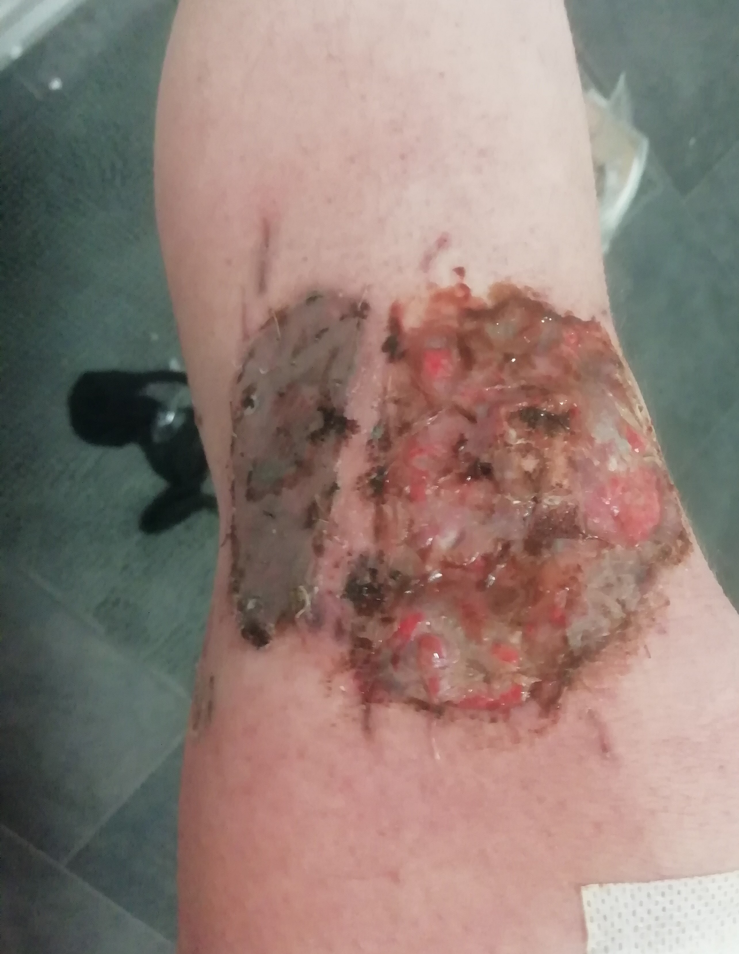 Blog about knee skingraft