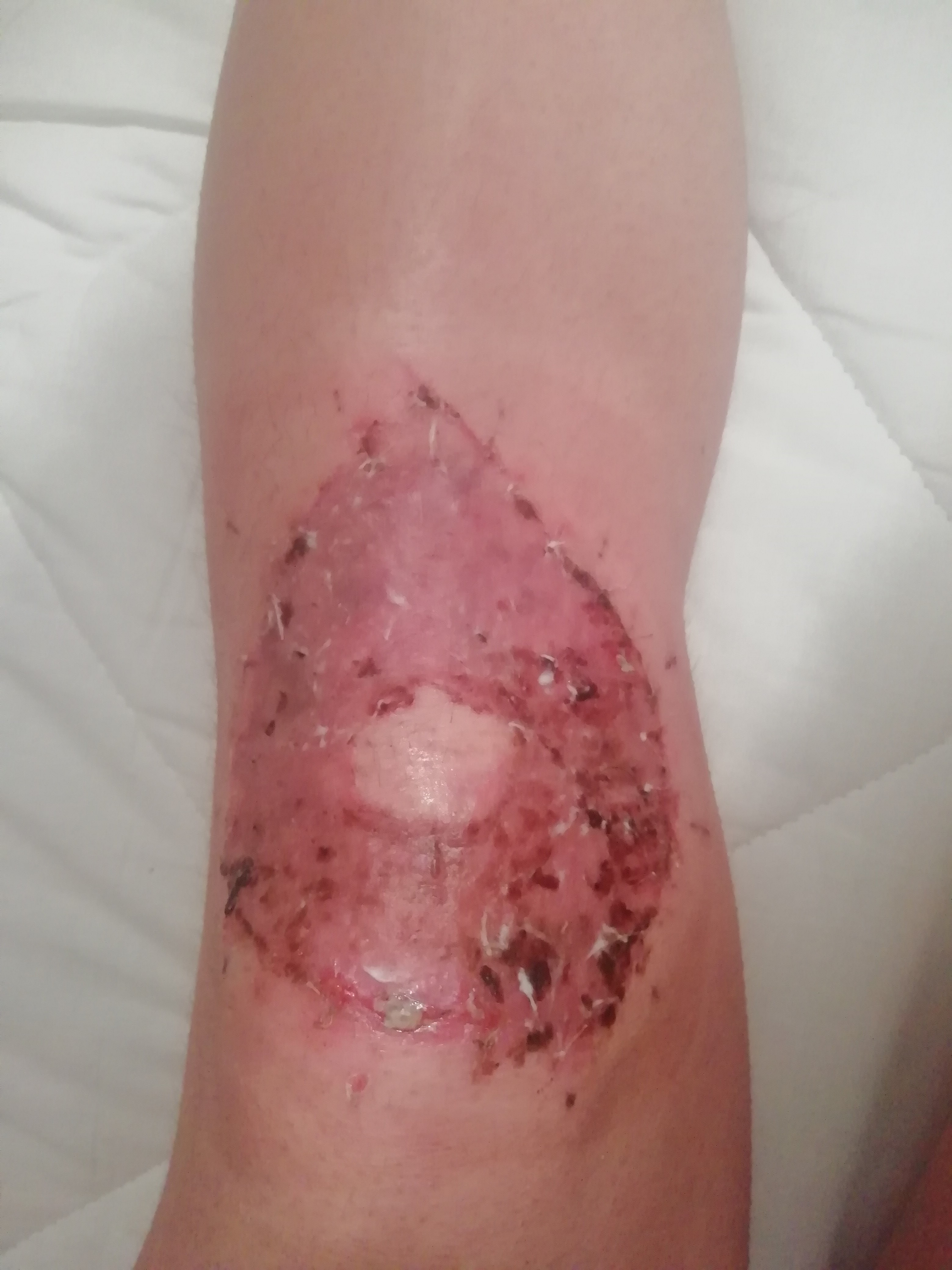 Blog about knee skingraft