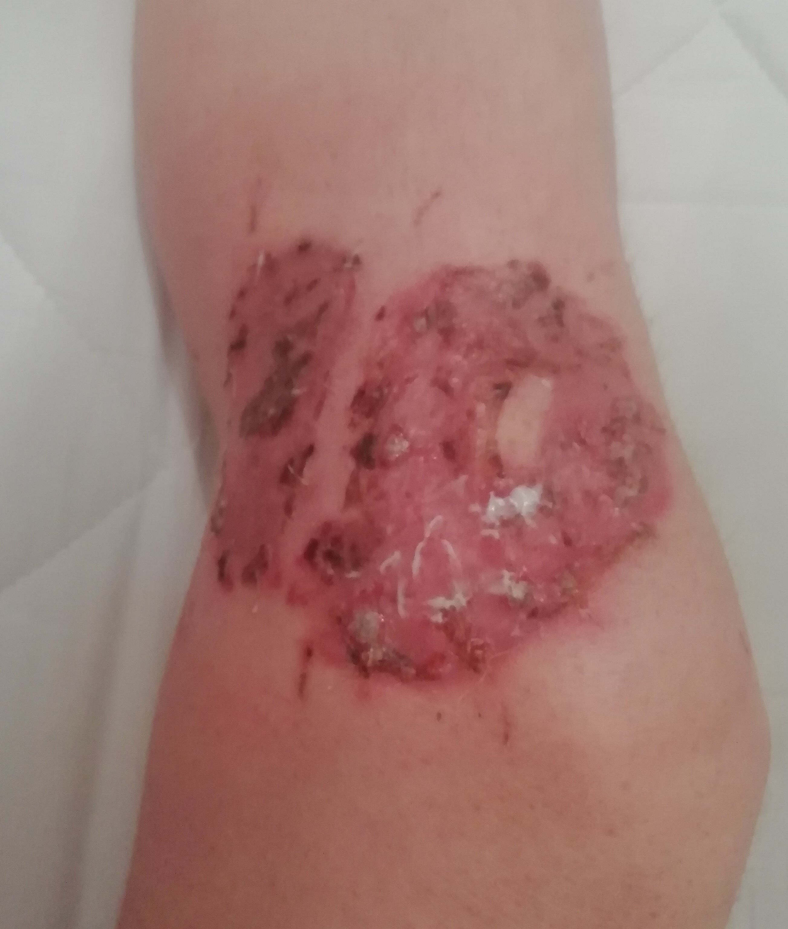 Blog about knee skingraft