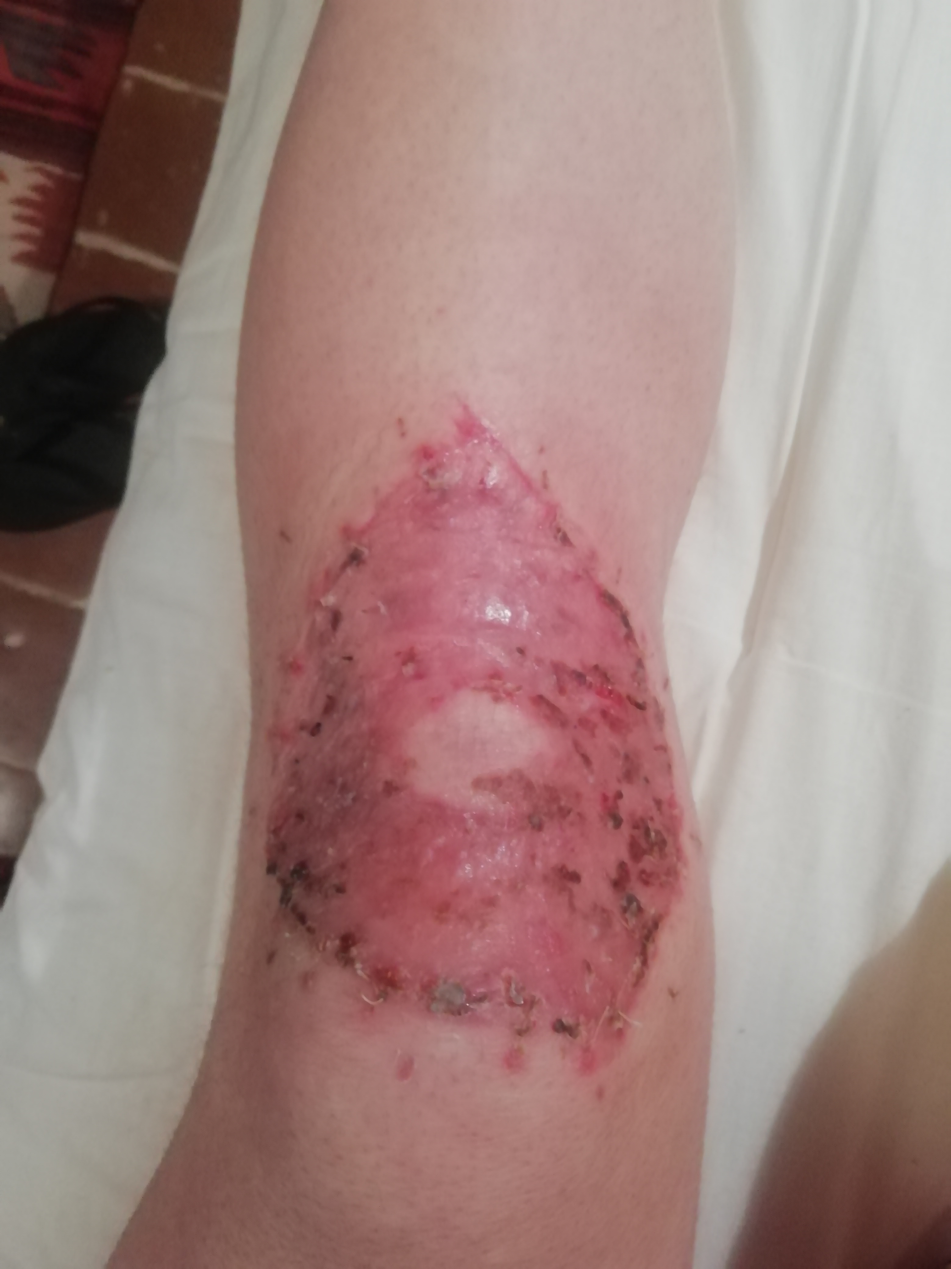 Blog about knee skingraft